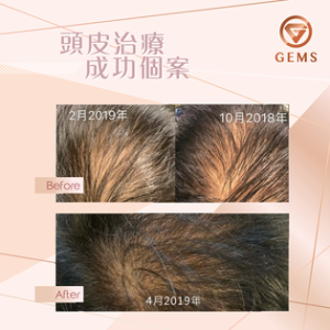 【?活力能量生髮治療??生生髮 $338/1次】